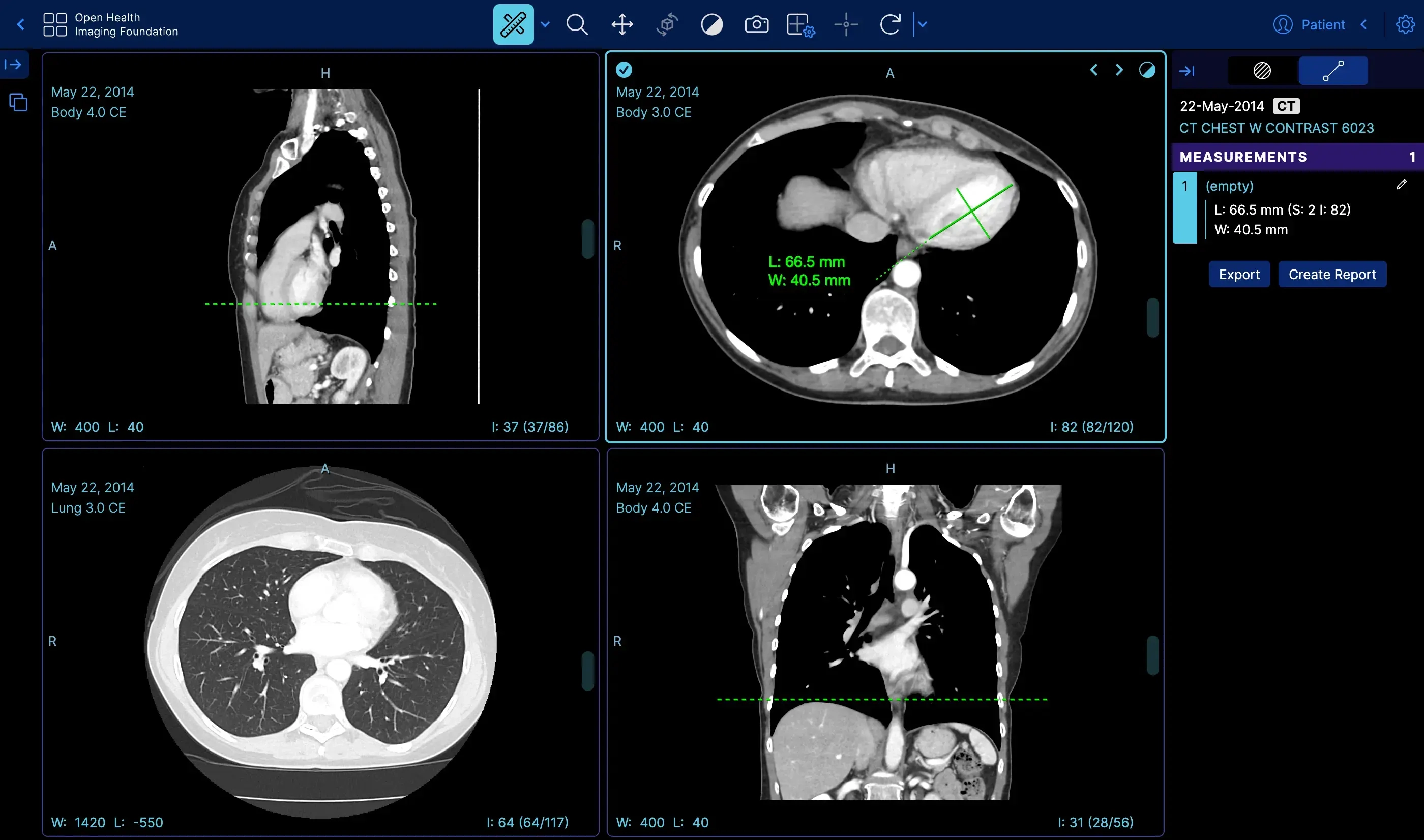 OHIF browser-native medical imaging viewer showing multiple viewports, study context, tools, and measurement panels inside a web application.